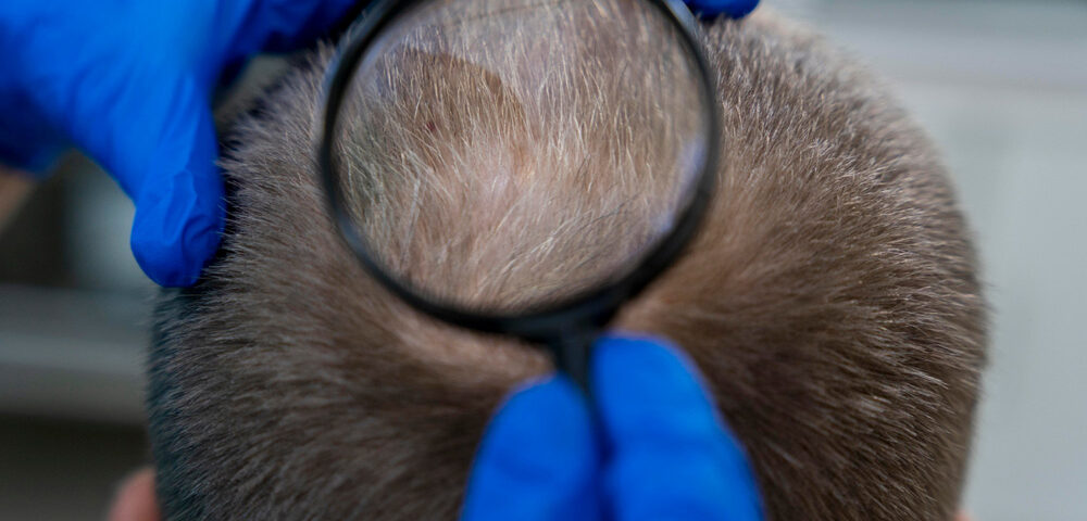 زراعة الشعر في مشهد 6 زراعة الشعر في مشهد