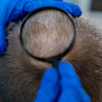 زراعة الشعر في مشهد 5 زراعة الشعر في مشهد