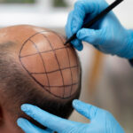 عيادة زراعة الشعر في مشهد 4 عيادة زراعة الشعر في مشهد