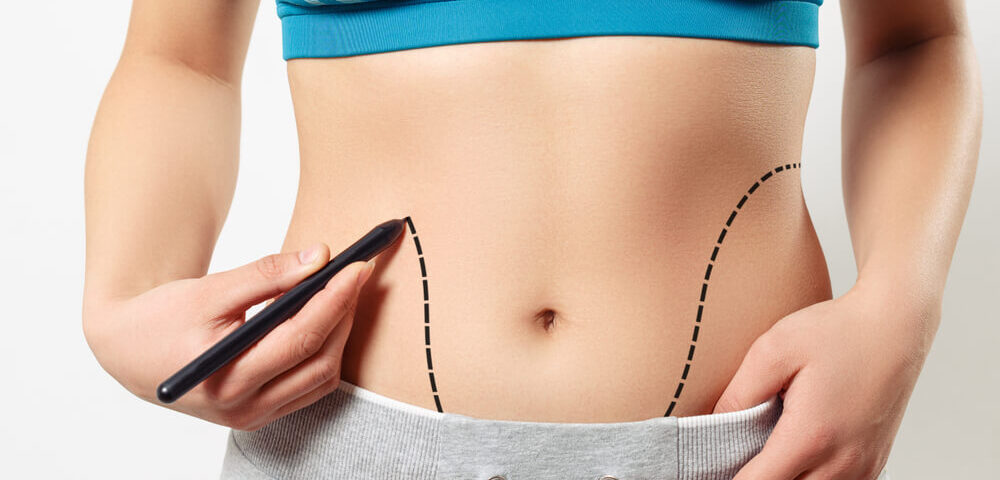 ليپوساكشن في مشهد: الطريق الآمن لنحت الجسم للمرضى العرب 6 ليپوساكشن في مشهد